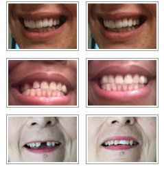 temporary tooth replace results