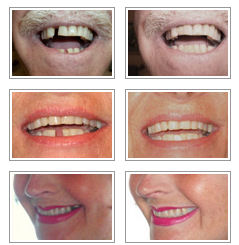 client photos before and after replacing a missing tooth