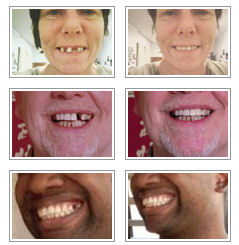 lost tooth replaced using TempTooth