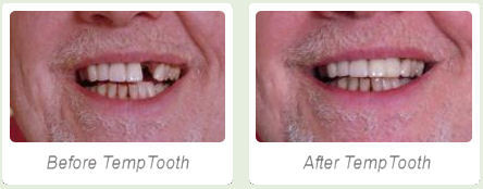 photo shows before and after of person missing a tooth