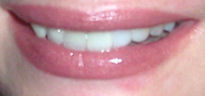 lovely smile after replacing missing tooth with TempTooth
