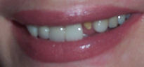 unsightly smile with missing tooth